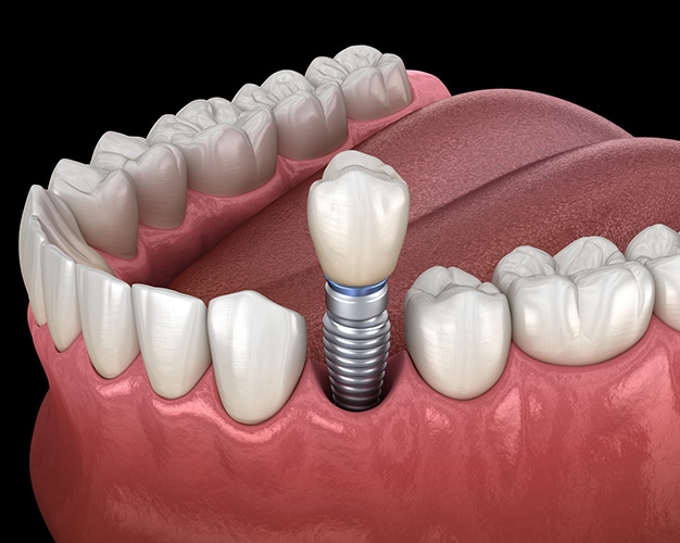 Dental implant illustration showing prosthetic tooth anchored in jawbone with surrounding natural teeth.