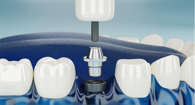 Dental implant diagram showing screw fixture between natural teeth in jawbone model.