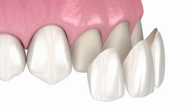 Digital rendering of dental crowns on implants with pink gum tissue model.