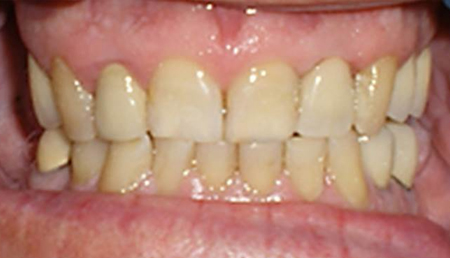 Close-up of aligned teeth showing orthodontic treatment results in dental office setting.
