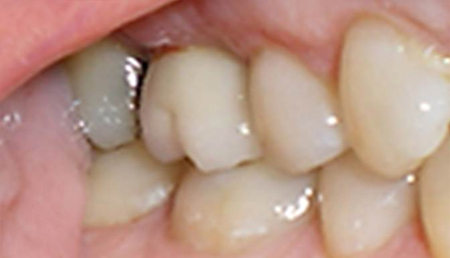 Close-up dental photograph showing upper and lower teeth with visible plaque buildup and discoloration.