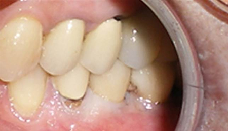 Close-up dental view showing natural teeth alignment and healthy gum tissue in oral cavity.