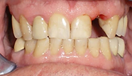 Close-up view of teeth showing dental alignment and natural tooth color in clinical setting.
