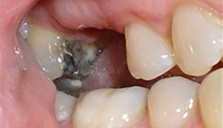 Dental implant placement showing metal post inserted into jawbone during oral surgery procedure.
