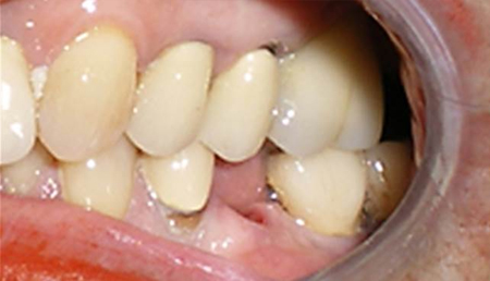 Close-up dental view showing upper teeth with visible spacing and dental work in clinical setting.