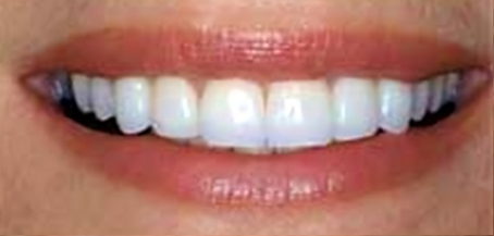 Close-up of a bright white smile showing straight teeth and healthy gums in a professional dental setting.