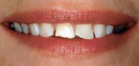 Close-up of a smile showing teeth with visible gaps and discoloration, demonstrating orthodontic concerns.