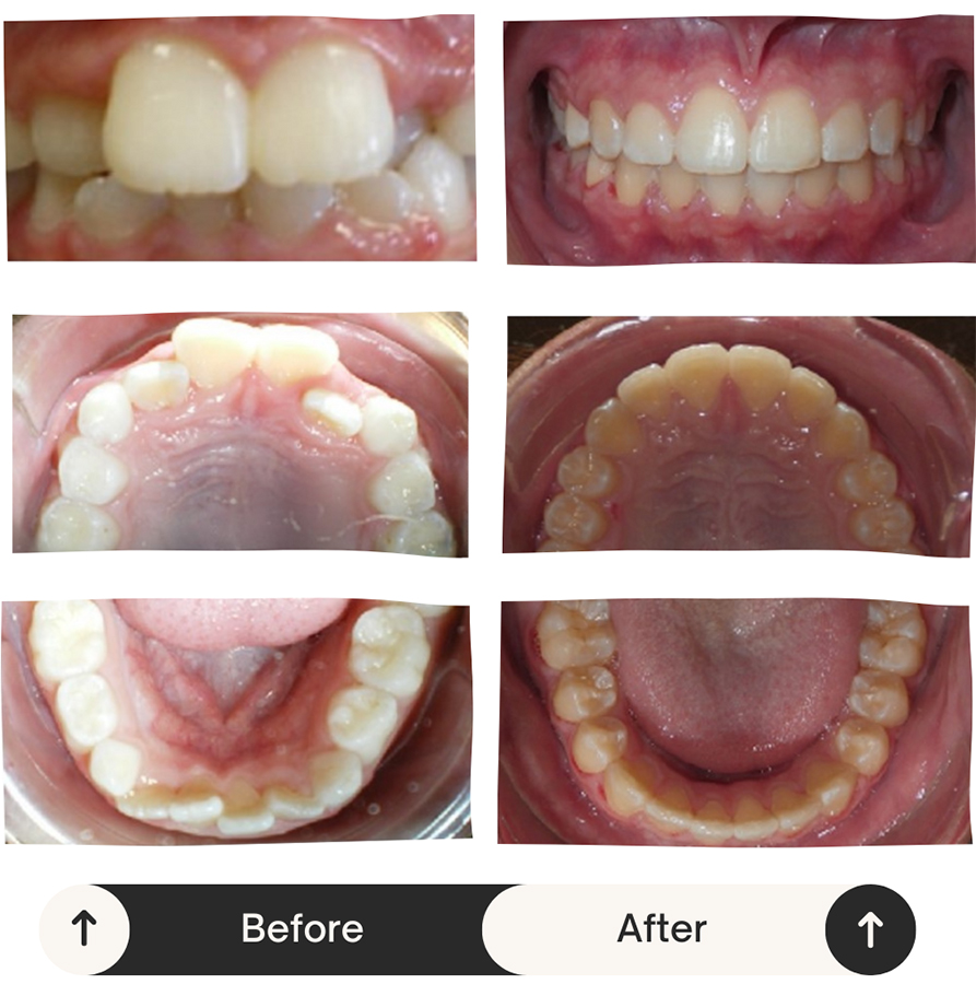 Before and after dental transformation showing improved tooth alignment and whitening results.