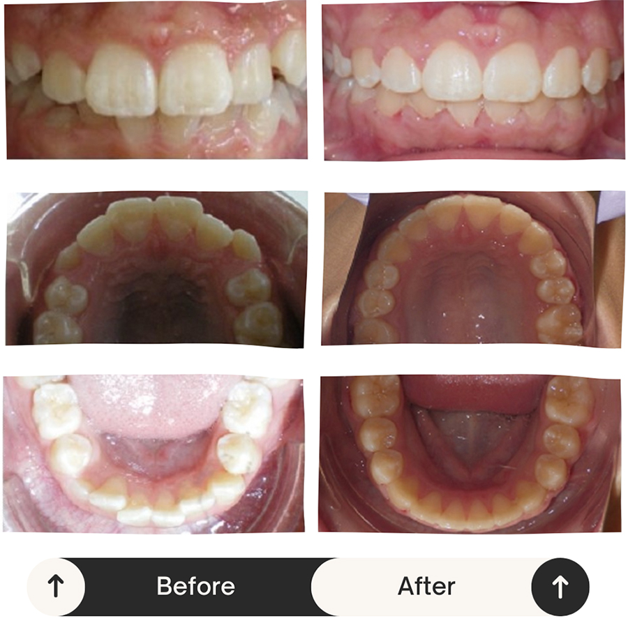 Dental before and after comparison showing tooth alignment and whitening results from orthodontic treatment.