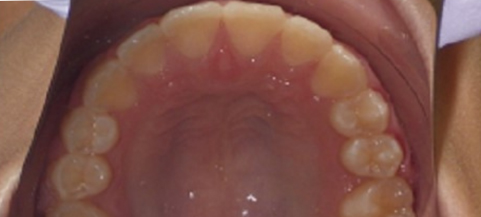 Close-up intraoral view of upper dental arch showing teeth alignment and oral tissues.
