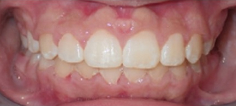 Close-up of healthy upper front teeth showing proper alignment and white enamel against pink gums.