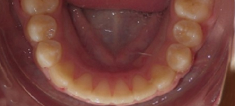 Intraoral view of lower teeth and gums showing dental alignment and oral health condition.