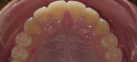 Intraoral view of upper dental arch showing natural teeth alignment and oral health examination.