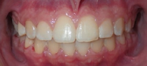 Close-up of upper front teeth showing natural smile with healthy gums and white dental work.