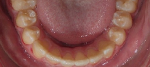 Intraoral view of lower teeth showing dental alignment and bite relationship during orthodontic examination.