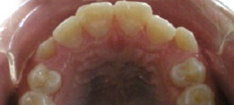 Intraoral view of upper dental arch showing natural teeth arrangement and oral cavity.