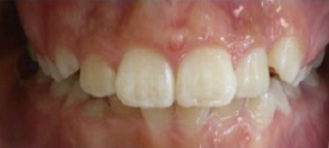 Close-up of healthy white teeth and pink gums showing proper dental alignment and oral health.
