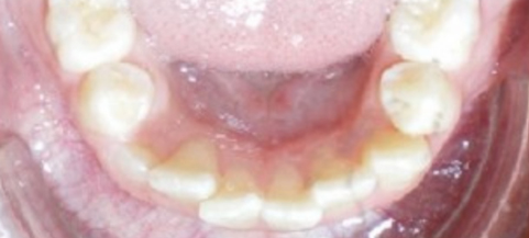 Intraoral view of lower front teeth showing dental alignment and oral cavity during examination.