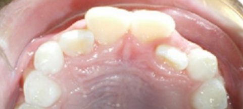 Intraoral view of upper dental arch showing white teeth and pink gum tissue from above.