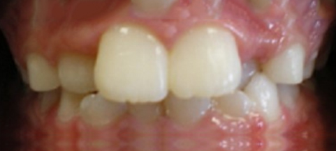 Close-up of upper front teeth showing dental work and natural tooth alignment in a smile.