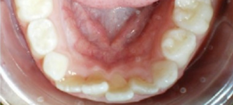 Intraoral view of upper teeth and palate showing dental alignment and oral tissues.